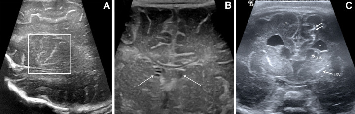 Cranial US patterns in infants exposed to Zika virus. (A, B) Cranial US scans in infants with normal head size and mild pattern. (A) Parasagittal cranial US scan in 19-day-old boy shows linear hyperechogenicities in thalamus (square) consistent with lenticulostriate vasculopathy. (B) Coronal cranial US scan in 20-day-old girl shows bilateral subependymal cysts (arrows). (C) Coronal cranial US scan in 4-day-old boy with microcephaly and Zika virus–like pattern shows brain volume loss with bilateral ventriculomegaly (*). Bandlike subcortical calcifications (double arrows) are shown at left. Malformations of cortical development (#) are seen bilaterally. Bilateral subependymal cysts (SEC) and lenticulostriate vasculopathy (LSV) are also shown.