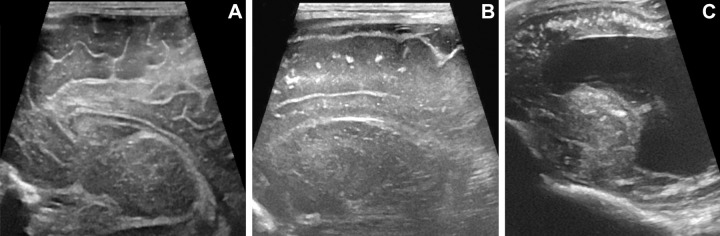 Comparison of Zika–like pattern and normal cranial US findings in infants exposed to Zika virus. (A) Normal cranial US scan in 15-day-old boy. Parasagittal scan shows expected sulcation pattern of frontal lobe. (B) Cranial US scan in 26-day-old boy with normal head size and Zika virus–like pattern. Compared with A, there is paucity of sulci in frontal lobe with smooth appearance, poor differentiation between cortex and subcortical white matter, and coarse calcifications along subcortical region. (C) Cranial US scan in 2-day-old girl with microcephaly and Zika virus–like pattern. No sulcation is seen in frontal lobes. There are diffuse coarse, coalescent, and hyperechogenic foci within subcortical white matter consistent with calcifications. Severe ventriculomegaly is also seen.