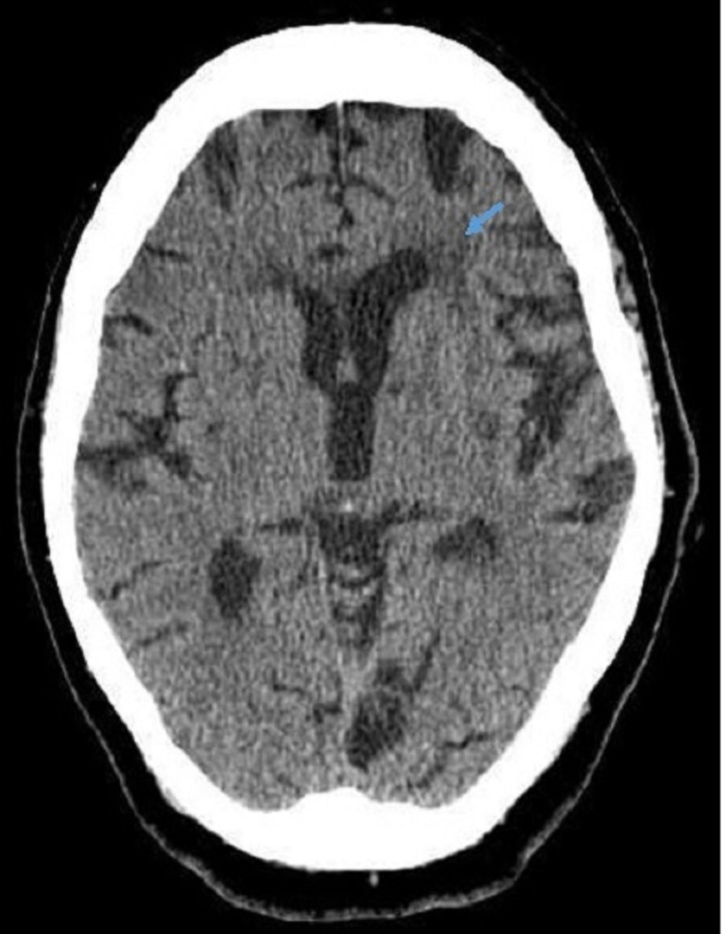 Angioedema a life threatening complication of tissue plasminogen