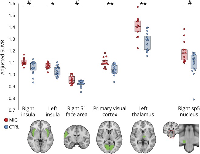 Imaging of neuroinflammation in migraine with aura: A [11C]PBR28 PET ...