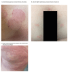 Three photographs showing examples of the skin lesions.
