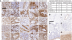 Figure 1. EDB+FN is expressed in the ECM of multiple tumor types with restricted expression in normal tissues. A, Panels of breast cancers, NSCLCs, ovarian cancers, head and neck cancers, and pancreatic cancers were IHC stained for EDB+FN, demonstrating widespread ECM and stromal reactivity in the majority of tumors (inset table). B–G, Normal human tissues including heart (B), kidney (C), liver (D), lung (E), small intestinal muscularis mucosae (F), and muscularis externa (G) were stained for EDB+FN. Micron bar = 300 μm.