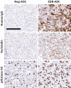 Figure 3. EDB-ADC localizes to the tumor microenvironment and induces mitotic arrest in tumor cells. Pharmacodynamic IHC to interrogate mechanism of action of EDB-ADC in H1975 tumors 48 hours after a single 3 mg/kg ADC dose, demonstrating ADC distribution (top row as visualized by human IgG antibody IHC) and auristatin payload distribution (middle row, anti-auristatin IHC) in the tumor stromal/ECM compartment, and downstream increase in phospho-histone H3 (pHH3) expression (bottom row). Micron bar = 300 μm.