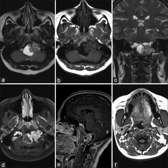 A rare case of hypoglossal nerve schwannoma presenting as hemiatrophy