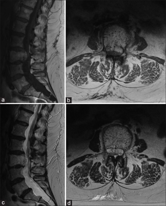 Integrated treatment of a lumbar vertebral hemangioma with spinal ...