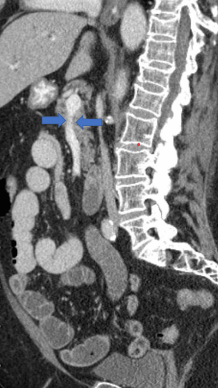 Enigma of Bowel Angina: Unraveling Celiac Trunk Stenosis - PMC