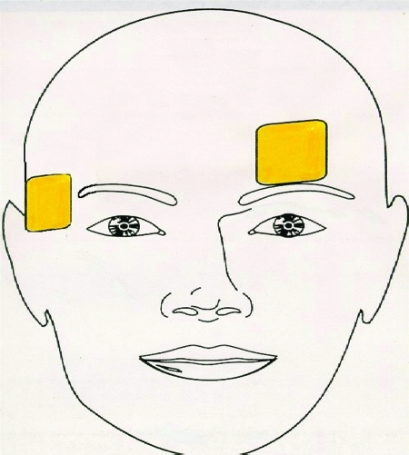 Rational Electroconvulsive Therapy Electrode Placement - PMC