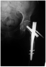 <b>Fig. 4</b>: Screw cut-out (hip pin backing out).