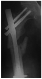 <b>Fig. 5</b>: Ten degree varus deformity of the femur.