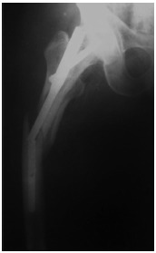 Fig. 2: Nail breakage at the distal interlocking level.