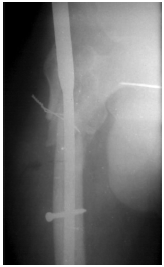<b>Fig. 3</b>: Intraoperative femoral shaft fracture.