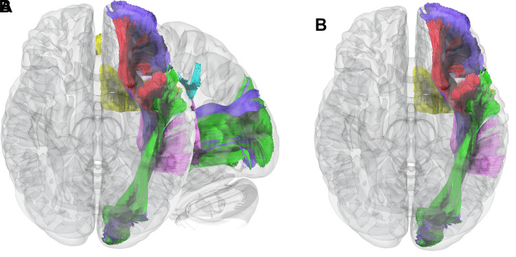 Critical white matter connections of the language systems. (A) Sagittal and (B) inferior axial MR tractography images show the relationship of several of the primary connections of the language system. The ventral semantic stream primarily consists of the inferior fronto-occipital fasciculus (purple), inferior longitudinal fasciculus (green), and uncinate fasciculus (red). The dorsal phonologic stream primarily consists of the arcuate fasciculus (pink) and the lateral portion of the superior longitudinal fasciculus (cyan). The frontal aslant tract (yellow) connects the frontal opercular language areas with the presupplementary motor area and is a critical component of verbal fluency.