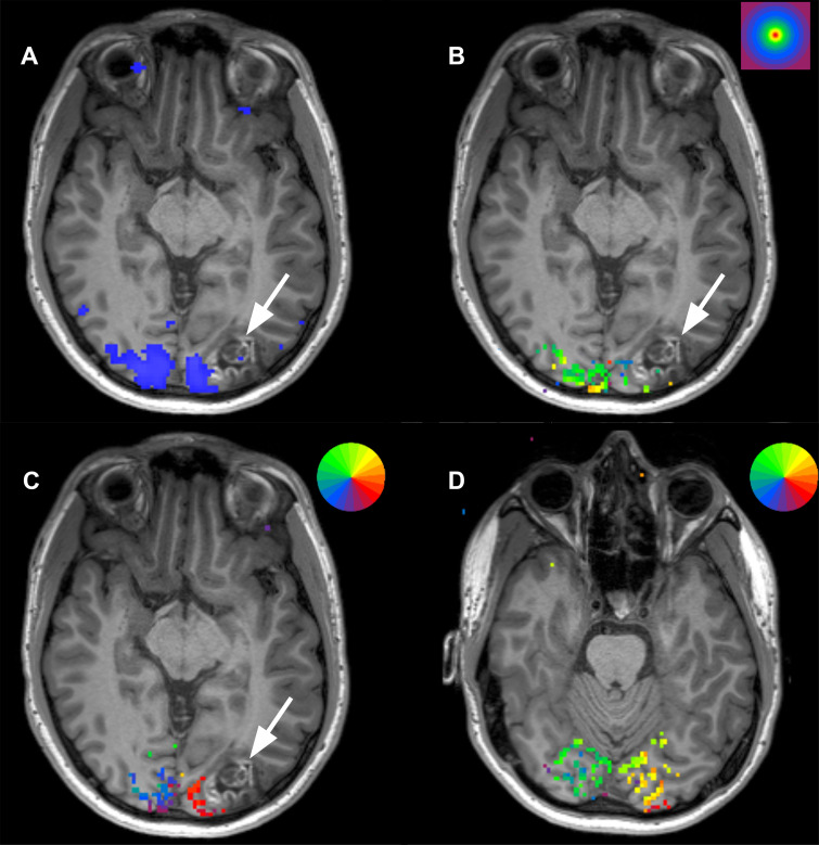 Scans from presurgical retinotopic mapping functional MRI in a 24-year-old man with a left occipital lobe ganglioglioma (arrow). (A) Image obtained during axial checkerboard vision task shows the primary visual cortex (blue) to lie medial to the lesion. (B) Concentric ring paradigm shows the lesion to occupy cortical representation of areas outside of the fovea (stimulus key in right upper corner; fovea = red). (C) Rotating wedge paradigm maps at the level of the lesion show activation in the area of the patient’s inferior outer quadrant, suggesting surgical risk for right inferior quadrantanopia (stimulus key showing color representation of visual fields in right upper corner; the visual field representation in the brain is inverted and flipped right-to-left such that right inferior visual quadrant is represented in the superior left occipital lobe. (D) More inferior image shows that the superior quadrant visual field is not within proximity to the lesion.