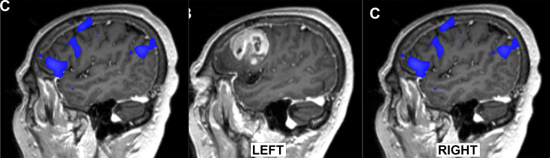 Images from presurgical functional MRI (fMRI) for language mapping. (A) Sagittal fMRI scan in a 45-year-old woman with a left frontal low-grade glioma (arrow) shows close proximity of the lesion with the ventral premotor cortex (red) from a sentence completion task. Activation from a reading comprehension task is shown in magenta, with activation in the inferior frontal gyrus corresponding to the traditional Broca area. (B) In a second patient, a 73-year-old woman with a left frontal high-grade glioma, there is no activation present in the left hemisphere during a sentence completion task. (C) In the same patient, there is right hemisphere–dominant language function (blue) on the sentence completion task showing the ability of task-based fMRI to correctly help lateralize this atypical language organization, which was confirmed intraoperatively.