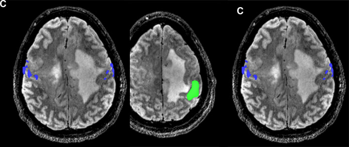 Images from presurgical functional MRI in a 30-year-old man with grade 3 IDH-mutant astrocytoma. (A) Axial image of right foot motor function (magenta) shows localization along the medial aspect of the lesion, with supplementary motor area activation (arrow) in the right hemisphere, suggesting reorganization. (B) Right hand motor function (green) is shown in the left hemisphere hand knob area along the posterolateral border of the lesion. (C) Tongue motor function (blue) is present in the lateral precentral gyrus along the lateral border of the lesion.