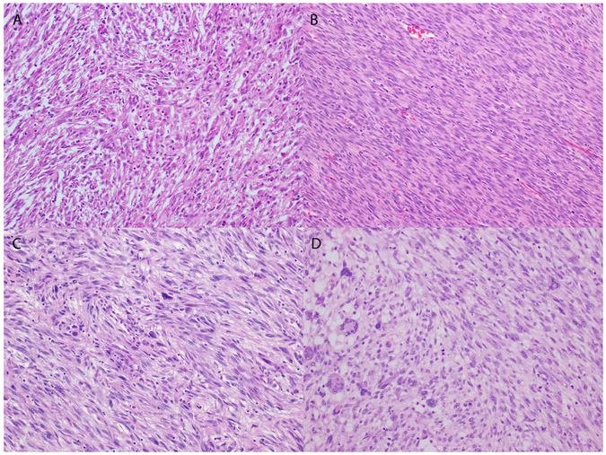 NTRK Fusions Define a Novel Uterine Sarcoma Subtype with Features of ...