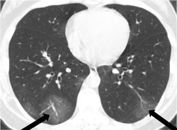 A 44-year-old woman with fever for 3 days, lymphocytopenia, and a traveling history to Wuhan in January 2020. Axial chest CT image shows bilateral peripheral multifocal ground-glass opacities (arrows).