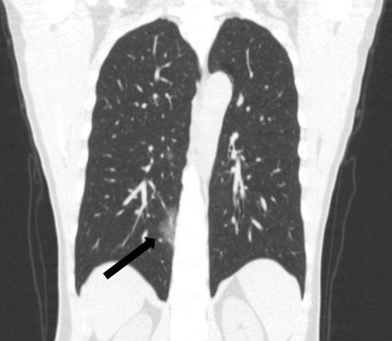 A 45-year-old man, with an exposure history of working in Wuhan, presenting with a fever for 2 days, a cough, and a sore throat. (a) Coronal and (b) sagittal chest CT images show a focus of ground glass in the peripheral right lower lobe (black arrow) and a smaller focus of ground glass in the central right lower lobe (white arrow).