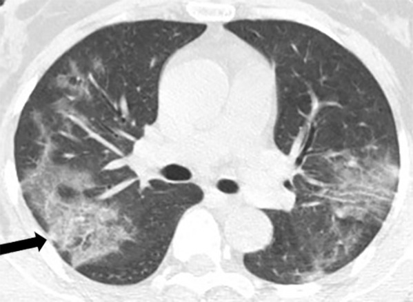 A 57-year-old man, a lifelong inhabitant of Wuhan, China, with a fever for 4 days, shivers, and a dry cough. Axial chest CT image shows peripheral and central multifocal ground-glass opacities with small foci consolidation (arrow).