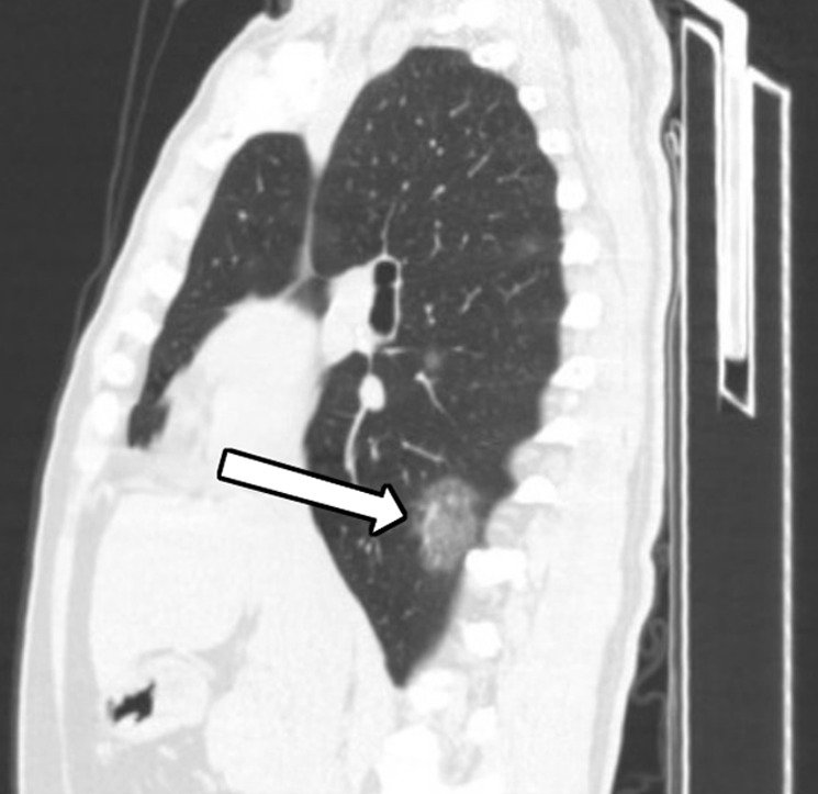 A 45-year-old man, with an exposure history of working in Wuhan, presenting with a fever for 2 days, a cough, and a sore throat. (a) Coronal and (b) sagittal chest CT images show a focus of ground glass in the peripheral right lower lobe (black arrow) and a smaller focus of ground glass in the central right lower lobe (white arrow).