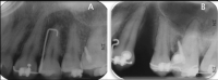 Figure 3. Periapical radiographs before (A) and after (B) extraction and interseptal reduction.