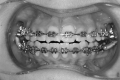 Figure 1. Application of Forsus Fatigue Resistant Devices to dental arches.