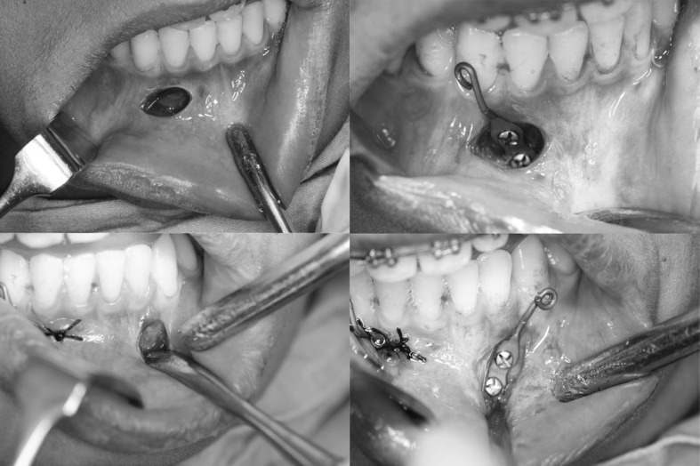 Figure 2. Surgical steps of miniplate insertion.