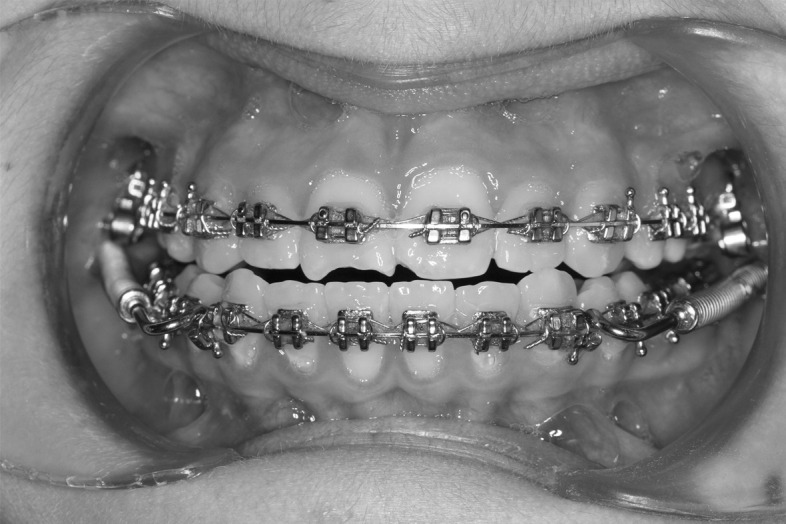 Figure 1. Application of Forsus Fatigue Resistant Devices to dental arches.