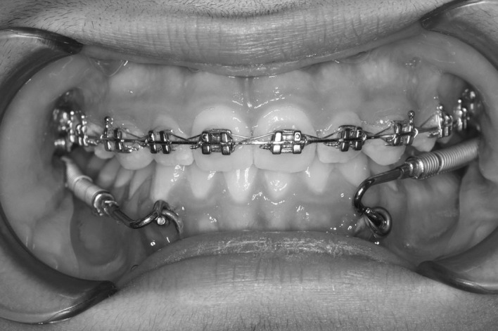 Figure 3. Application of Forsus Fatigue Resistant Devices to miniplates.