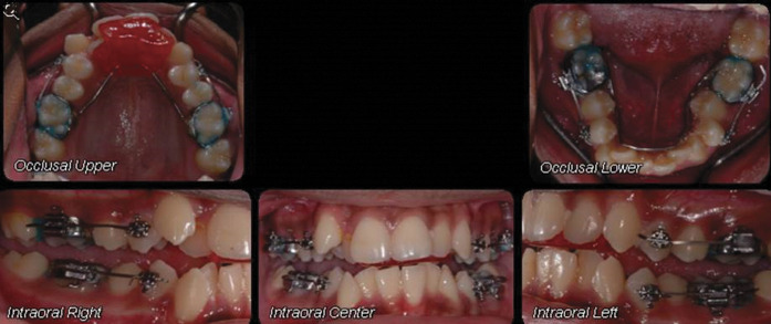 Figure 1. Intraoral pictures of the patient showing orthodontic appliances and arch wire.