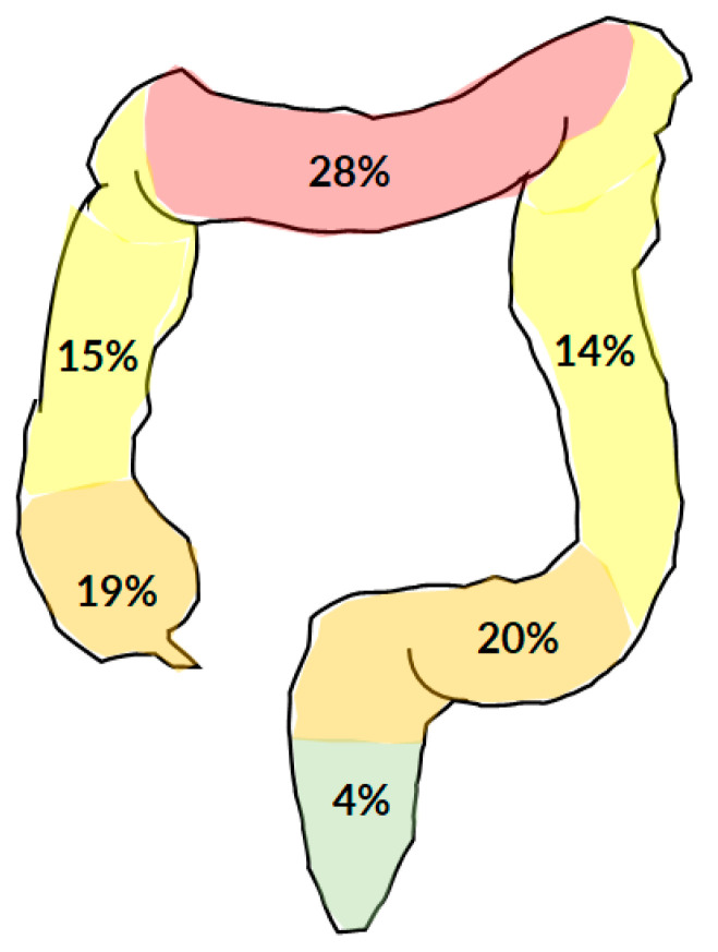 Colonic Lipoma Causing Bowel Intussusception: An Up-to-Date Systematic ...