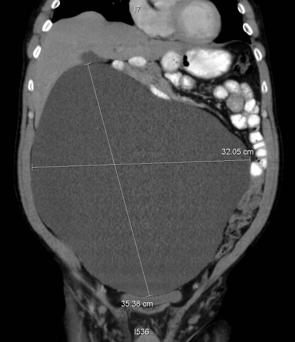 Mesothelioma as a rapidly developing Giant Abdominal Cyst - PMC