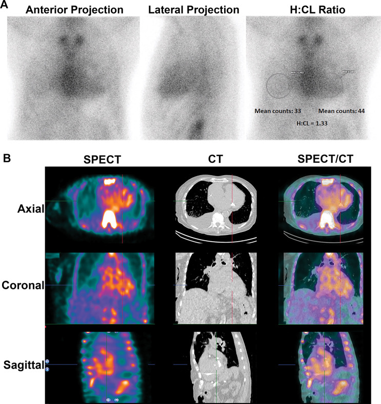 Planar and SPECT/CT technetium 99m (99mTc) pyrophosphate (PYP) images obtained for suspected transthyretin cardiac amyloidosis (ATTR-CA). (A) A 77-year-old White man with new onset of symptoms of heart failure underwent 99mTc-PYP planar scanning. The scan was reported as showing grade 3 myocardial uptake suggestive of ATTR-CA, and the patient was referred to our institution for initiation of tafamidis therapy. A careful review of the 99mTc-PYP planar images, which were reported to be acquired 1 hour after injection of radiotracer, suggested that tracer activity was concentrated in the blood pool and not in the myocardium because the typical appearance of a central clearing was not evident. Absence of rib uptake of tracer suggested that imaging was performed too early, making the images uninterpretable (see also Fig 2). H/CL = heart-to–contralateral lung uptake ratio, ROI = region of interest, 2D = two-dimensional. (B) SPECT/CT imaging at 3 hours is the preferred protocol at our institution, and it clearly demonstrates blood pool activity, with no myocardial 99mTc-PYP uptake in the rib. A definitive diagnosis of ATTR-CA based on interpretation of 99mTc-PYP planar images alone is not possible even for experienced readers.