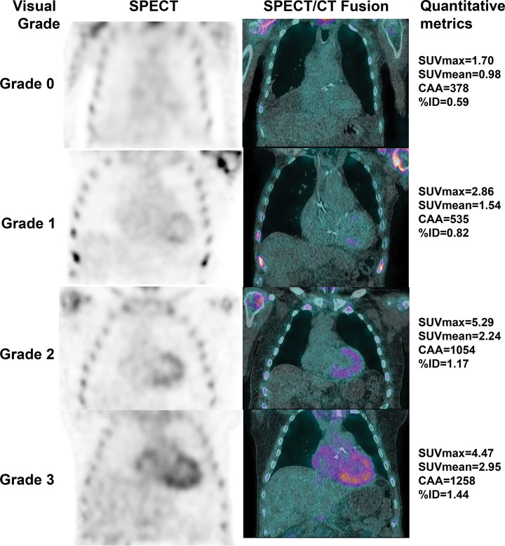 Visual grading and quantitative metrics from technetium 99m pyrophosphate SPECT/CT images. The left column shows attenuation-corrected SPECT images with visual grading labels; the right column shows SPECT/CT fusion images with corresponding maximum standardized uptake value (SUVmax), mean standardized uptake value (SUVmean), cardiac amyloid activity (CAA), and percentage injected dose (%ID) for each image.