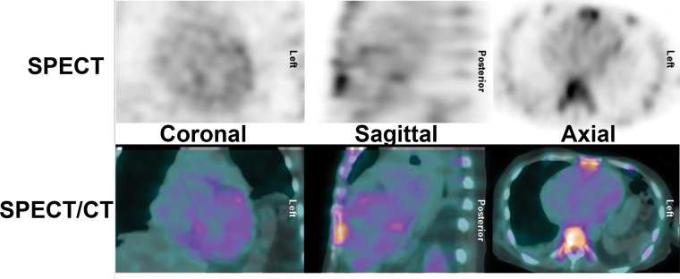 False-negative technetium 99m (99mTc) pyrophosphate (PYP) scan in hereditary transthyretin (ATTRv) amyloidosis. An 82-year-old African American man presented with symptoms of heart failure. Investigations revealed typical echocardiographic features of an infiltrative pathologic abnormality, and he was found to carry the Val122Ile (p.Val142Ile) transthyretin (ATTR) gene variant. His 99mTc-PYP SPECT/CT scan was, however, surprisingly, negative. The diagnosis of ATTRv cardiomyopathy was confirmed approximately 6 months later postmortem when the autopsy revealed extensive ATTR amyloid fibril deposition in the myocardium. Rarely, in patients with the Val122Ile (p.Val142Ile) variant, 99mTc-PYP scans can be negative. False-negative scans are more commonly encountered in patients with ATTRv with certain pathogenic ATTR variants, such as Phe64Leu (p.Phe84Leu) and Val30Met (p.Val50Met).