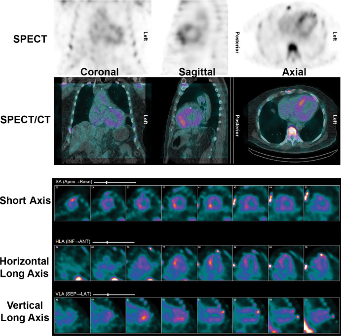 False-positive 99m technetium pyrophosphate (99mTc-PYP) scan in a recent myocardial infarct. A 72-year-old White man underwent 99mTc-PYP SPECT/CT for evaluation of suspected transthyretin cardiac amyloidosis due to increased left ventricular wall thickening at echocardiography. His medical history was notable for an acute myocardial infarct from a thrombotic occlusion of the left anterior descending coronary artery 10 days before 99mTc-PYP SPECT/CT. The scan shows focal intense tracer uptake, most pronounced in the septum as a sequela of the recent myocardial infarction. 99mTc-PYP myocardial uptake is less specific for amyloidosis in the setting of an acute myocardial infarction and may remain positive for 6 months after infarct. ANT = anterior, HLA = horizontal long axis, INF = inferior, LAT = lateral, SA = short axis, SEP = septal, VLA = vertical long axis.