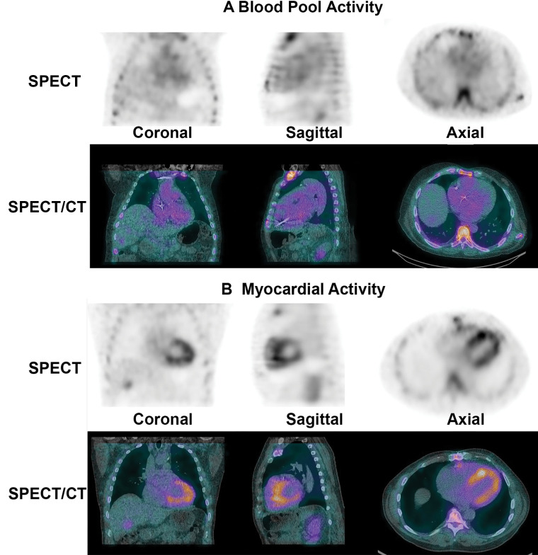 SPECT and SPECT/CT to distinguish myocardial technetium 99m pyrophosphate uptake from blood pool activity. (A) On SPECT and SPECT/CT images, tracer activity in the blood pool has an amorphous appearance that is not clearly separable from the mediastinum. (B) True-positive tracer uptake by the myocardium is characterized by a U shape or horseshoe shape on the axial and coronal planes and a donut shape on the sagittal plane.