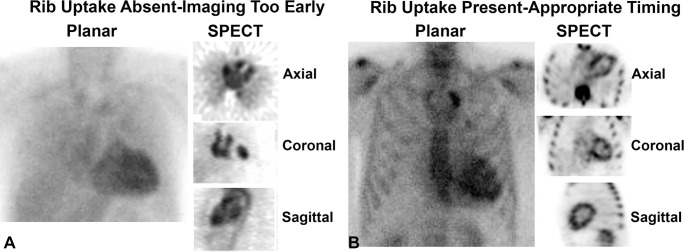 Rib uptake as an indication of appropriate timing of scan acquisition in technetium 99m pyrophosphate cardiac scintigraphy. (A) In the early phase shortly after tracer injection, blood pool activity within the heart is expected, while the ribs and other skeletal structures are not clearly visible. The absence of tracer uptake by the ribs is a good indicator that it is too early to interpret the scan, as the tracer is still circulating in the blood pool and has not entered the myocardium or bound to the bones. (B) In contrast, late images acquired 3 hours after radiotracer injection clearly show tracer uptake in the ribs. Any tracer uptake in the heart on 3-hour images should raise suspicion for myocardial uptake.