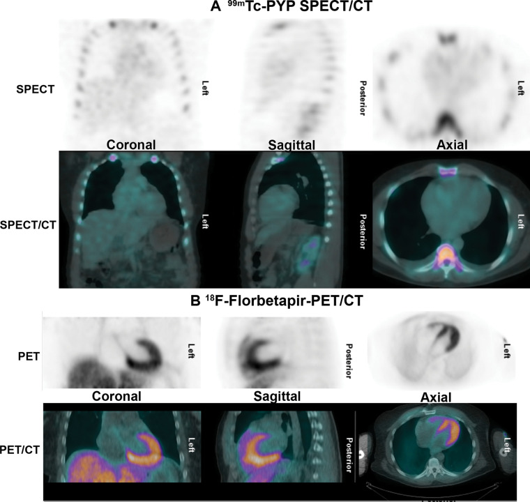 Negative technetium 99m (99mTc) pyrophosphate (PYP) scan in light chain (AL) amyloidosis. A 56-year-old African American man was evaluated with cardiac MRI for symptoms of heart failure. The cardiac MRI findings (not shown) were suggestive of amyloidosis, but (A) the 99mTc-PYP SPECT/CT images show grade 0 uptake. Further evaluation with serum and urine studies as well as bone marrow biopsy confirmed a diagnosis of systemic AL amyloidosis. (B) Fluorine 18 (18F) florbetapir PET/CT images acquired as a part of a research study demonstrate diffuse intense myocardial uptake consistent with AL amyloidosis. Amyloid PET tracers may be helpful to identify AL amyloidosis but are currently investigational.