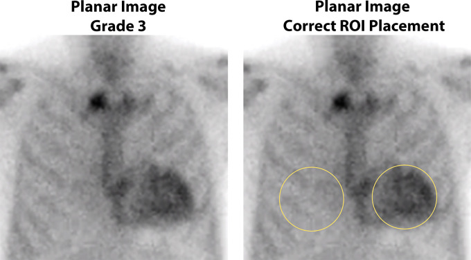 Semiquantitative method of heart-to–contralateral lung uptake ratio (H/CL ratio) uptake ratio on planar imaging at 1 hour after tracer injection. Anterior planar images acquired 1 hour after injection of technetium 99m pyrophosphate show grade 3 myocardial tracer uptake. Correct placement of regions of interest (ROIs) for the derivation of H/CL ratio is shown: The “heart” ROI should be drawn over the entire myocardium, and the “contralateral chest” ROI should be of the same size and mirrored over the contralateral chest on planar imaging at 1 hour. The ROI should be positioned to minimize overlap with sternal or focal rib uptake and maximize coverage of the heart without including adjacent lung. The H/CL ratio is optional and should only be reported if myocardial activity is noted on SPECT images.