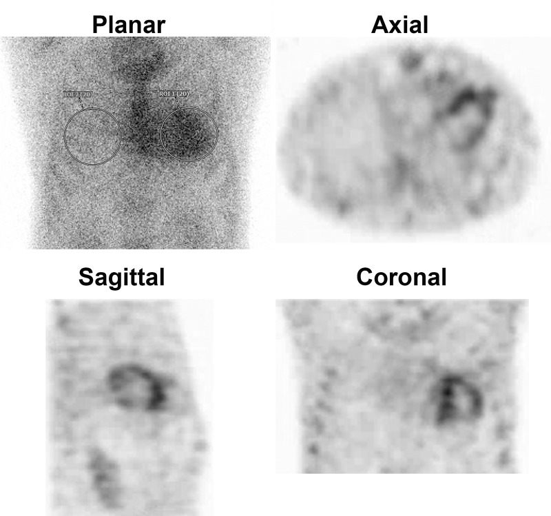 Technetium 99m (99mTc) pyrophosphate (PYP) scan positive for light chain (AL) amyloidosis. 99mTc-PYP planar images in a 67-year-old White man with suspected amyloidosis were strongly positive, with grade 3 uptake and an elevated heart-to–contralateral lung uptake ratio of 1.54. Myocardial uptake was confirmed on axial, sagittal, and coronal SPECT images. However, subsequent investigations confirmed the diagnosis of AL amyloidosis. Intense myocardial 99mTc-PYP uptake can be seen in more than 20%–30% of patients with AL amyloidosis; therefore, a monoclonal process must be excluded by means of serum/urine immunofixation electrophoresis and a serum free AL assay before a diagnosis of transthyretin cardiac amyloidosis is made based on a positive 99mTc-PYP scan. ROI = region of interest, 2D = two-dimensional.