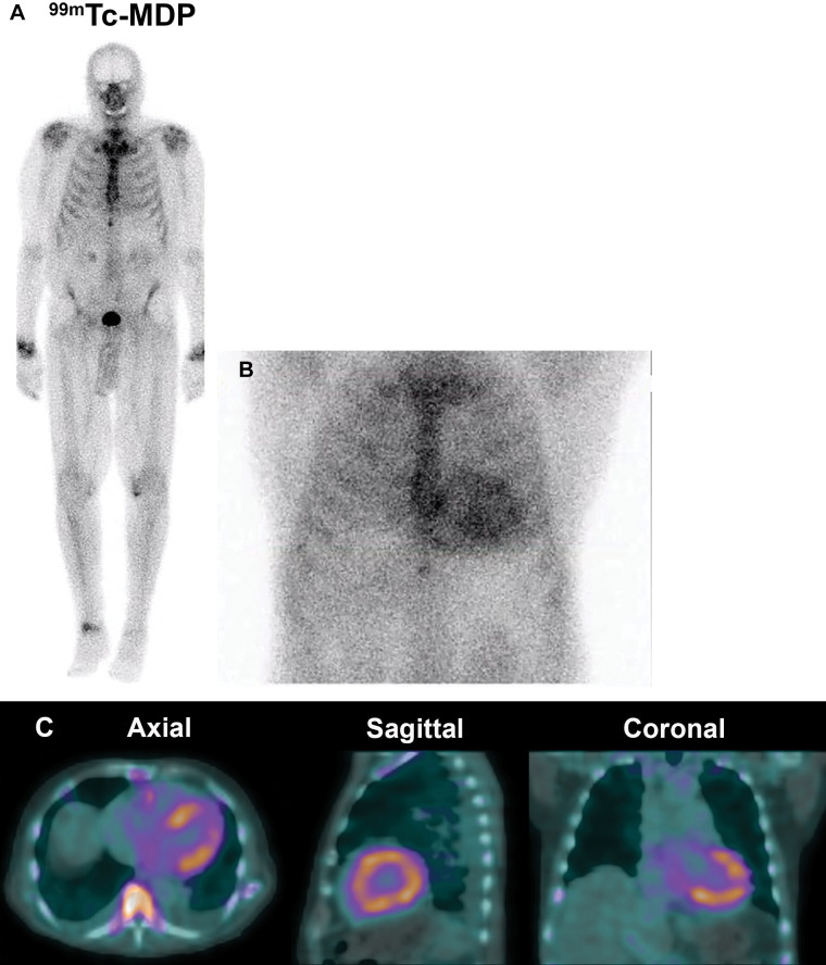 Negative technetium 99m (99mTc) methylene diphosphonate (MDP) bone scan in transthyretin cardiac amyloidosis (ATTR-CA). (A) 99mTc methylene diphosphonate planar whole-body bone scan for the evaluation of bone metastasis in a 79-year-old White man with newly diagnosed malignant neoplasm reveals no abnormal focal tracer uptake suspicious for bone metastasis and no appreciable tracer uptake in the heart. (B) 99mTc pyrophosphate planar scan and (C) SPECT/CT scan obtained 30 days later for the evaluation of ATTR-CA were strongly positive.