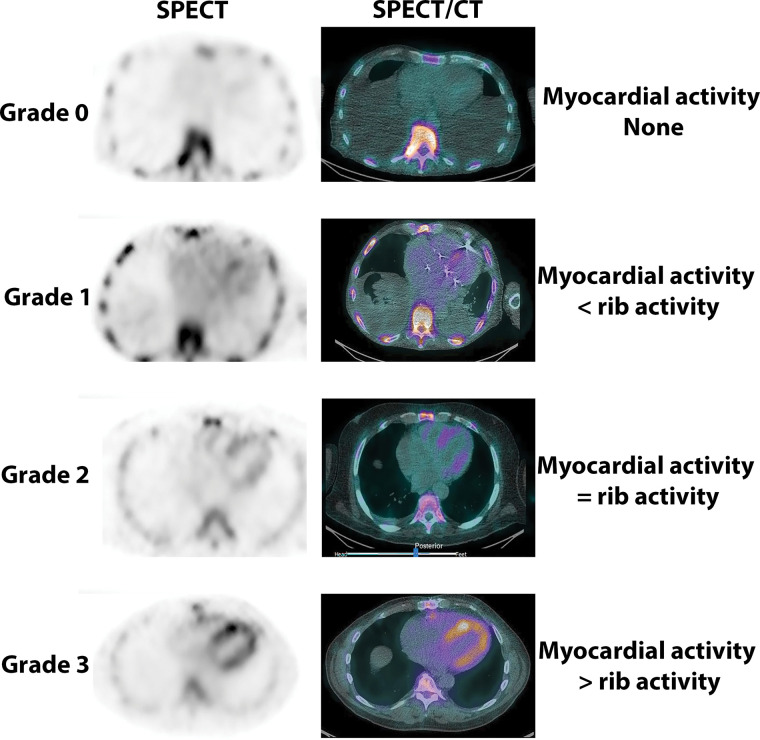 Visual grading of technetium 99m (99mTc) pyrophosphate (PYP) cardiac images. 99mTc-PYP axial SPECT images (left column) and SPECT/CT images (right column) demonstrate no myocardial uptake of PYP (grade 0) and myocardial tracer uptake less than rib uptake (grade 1), equal to rib uptake (grade 2), and greater than rib uptake (grade 3).