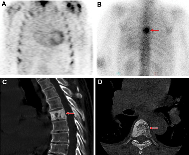 Review of technetium 99m (99mTc) pyrophosphate (PYP) images for extracardiac tracer activity. (A) 99mTc-PYP SPECT chest images in a 76-year-old White man with suspected cardiac amyloidosis show grade 2 uptake (ie, a positive finding). (B) Review of the entire image volume revealed an incidental focus of extracardiac intense tracer uptake (arrow) in the thoracic spine. (C) Sagittal and (D) axial CT images, which were obtained from the recommended CT examination, show cortical thickening and sclerosis of the T6 vertebral body (arrow), with coarse trabecular thickening. A bone biopsy was performed, as there was concern for bone metastasis, and final histologic results coupled with serum biochemistry findings were compatible with Paget disease.