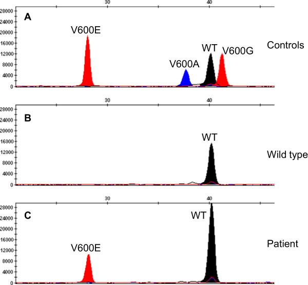 The clinical response to vemurafenib in a patient with a rare ...