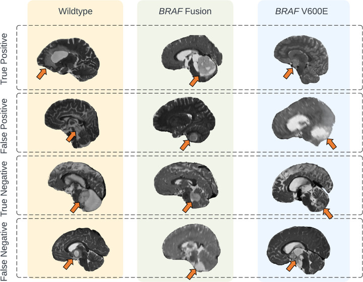 Representative prediction cases of the scan-to-prediction pipeline on the external dataset. The final scan-to-prediction pipeline consists of three subtype classifiers, trained using TransferX, further pooled together in consensus logic by the consensus decision block. Tumor lesions in the T2-weighted MRI scans are highlighted with arrows.