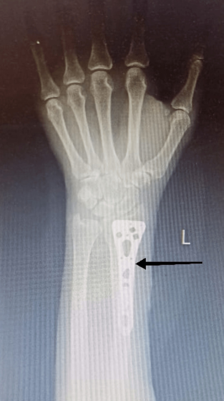 Physiotherapeutic Approach for Volar Barton Fracture Left Side Without ...