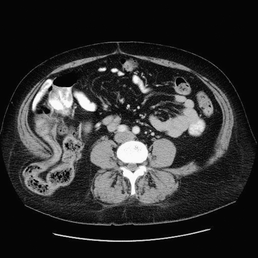 Lumbar Incisional Hernia Repair After Iliac Crest Bone Graft - Pmc