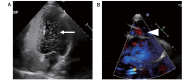 Fig.2. High-risk patent foramen ovale