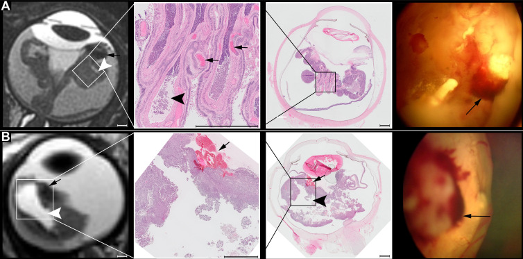 Axial MRI scans (left column), histopathologic images (middle columns), and fundoscopic images (right column) in two children with MYCN-amplified RB1 wild-type (ie, MYCNARB1+/+) retinoblastoma, (A) a 42-month-old boy and (B) 3-month-old girl. MRI scans show peritumoral hemorrhage (black arrows) and retinal detachment with multiple retinal folds with vitreous enclosure (black and white arrowheads). Scale bars of 25 mm are shown in the bottom right corner. Fundoscopic images show extensive peritumoral blood (black arrows, without spatial correlation).